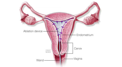 Abnormal Uterine Bleeding