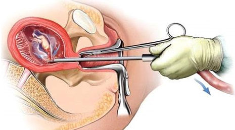 Abortion (Surgical & Medical)